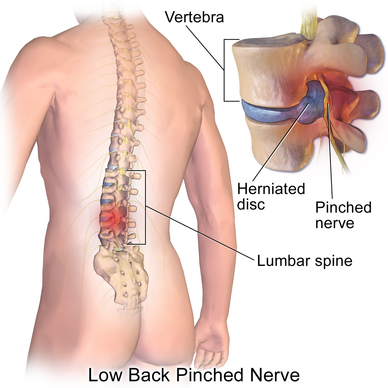 Anatomical illustration of a herniated lumbar disc pressing on a spinal nerve