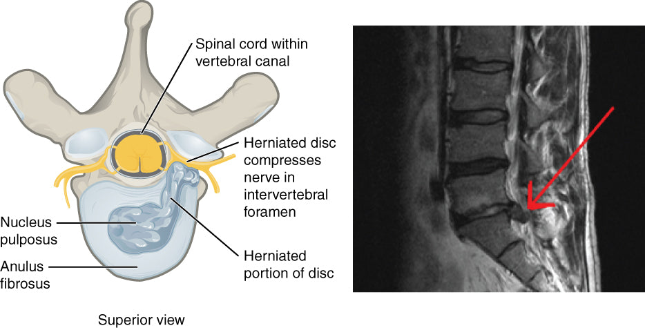 Illustration of a herniated lumbar disc at the L4-L5 level