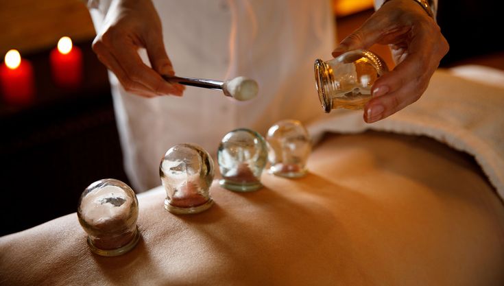 Cupping cups lined along a person's back, a practitioner with a flame