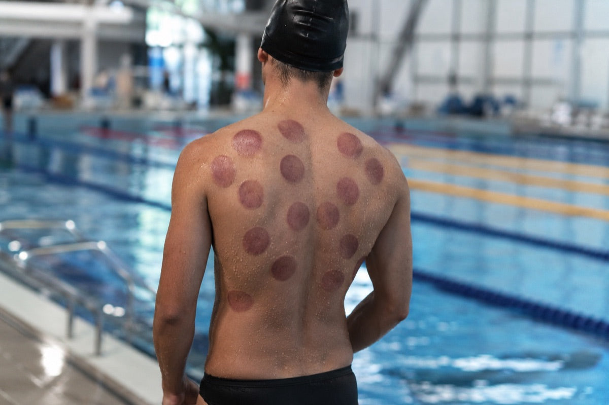 An anonymous competitive swimmer seen from behind with round cupping marks across the shoulders
