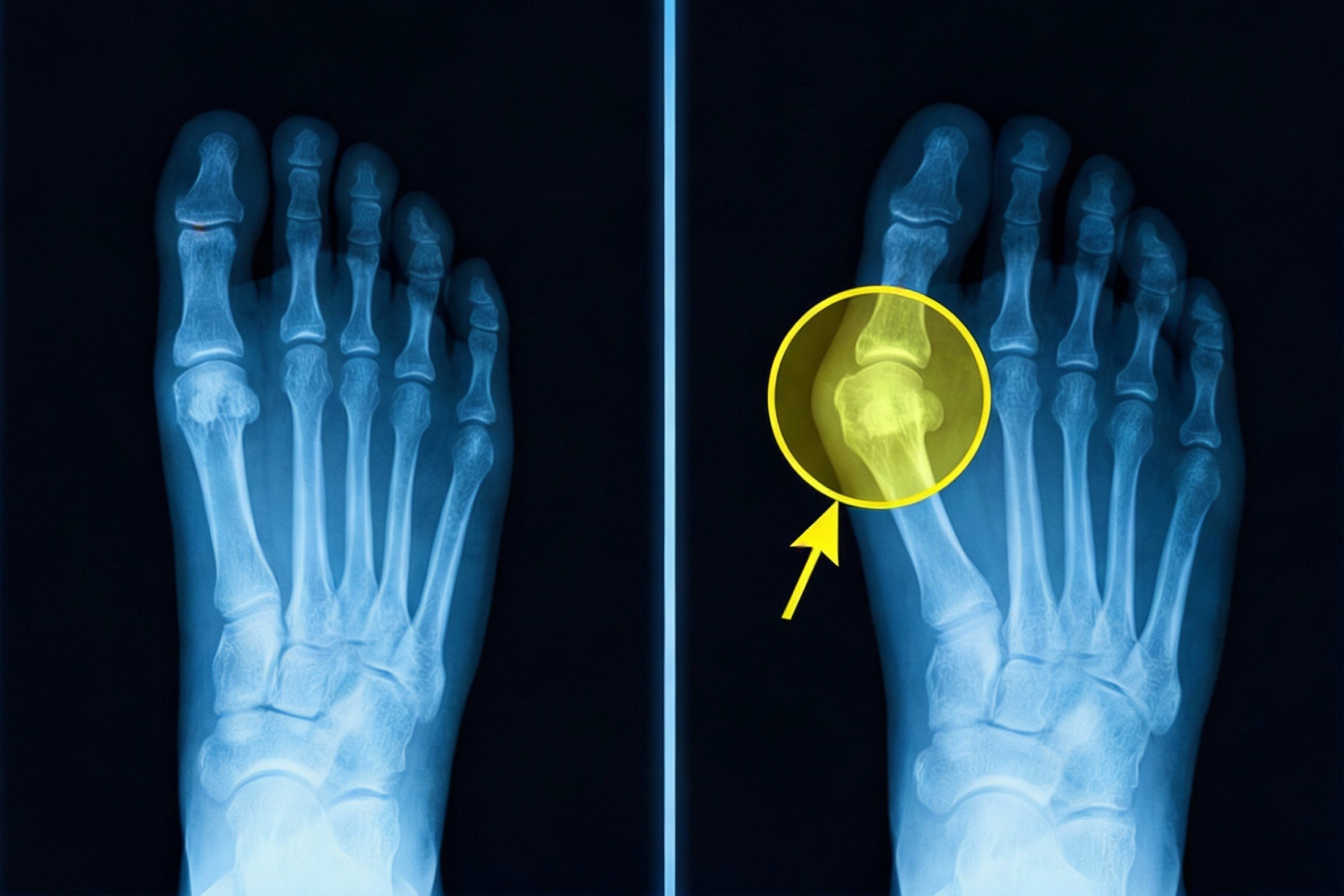 X-ray comparison: a normal foot beside a bunion foot with the drifted big-toe joint circled