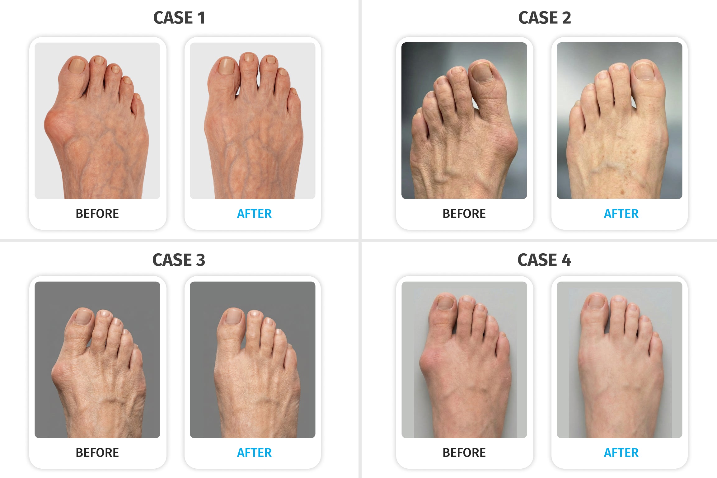 Before and after comparison of four bunion cases
